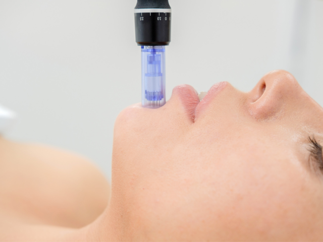 Microneedling, die Anti-Aging Geheimwaffe